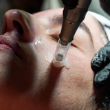 XO8 Microneedling & NanoInfusion Recovery Package